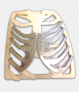 Richard Cole_Chest Wall Implant